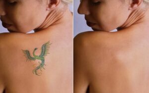 پاک کردن تتو قدیمی