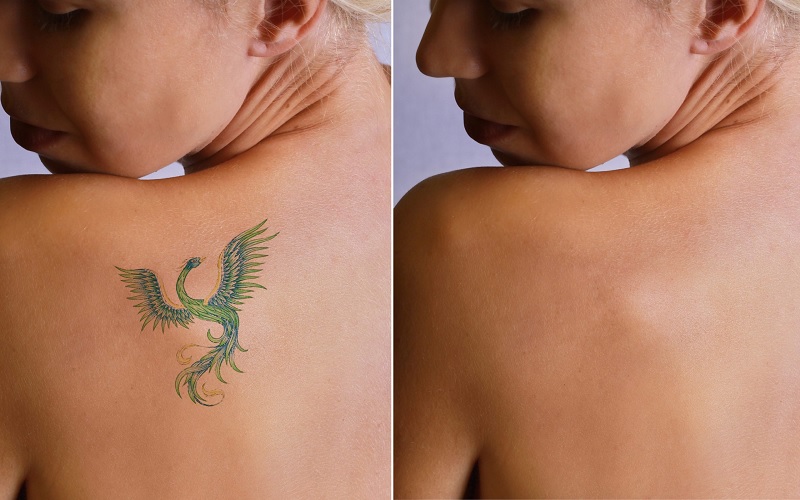 پاک کردن تتو قدیمی